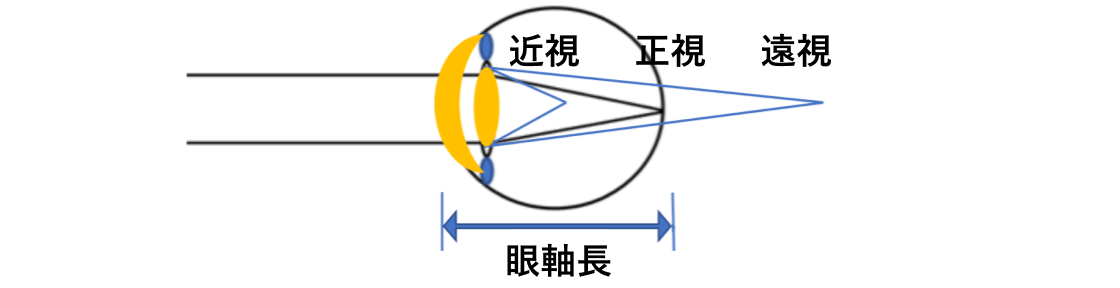 正視、近視、遠視の焦点のイメージ図